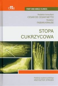 Picture of Stopa cukrzycowa